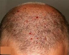 Image result for Bacterial Folliculitis Scalp