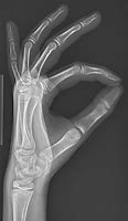 Image result for Normal Hand Radiograph