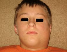 Image result for Mumps