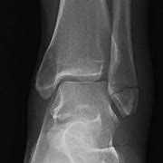 Image result for Left Lateral Malleolus Fracture