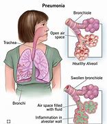 Image result for Childhood Pneumonia