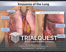 Image result for Pathophysiology of Empyema