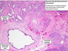 Image result for Pancreatic Adenocarcinoma