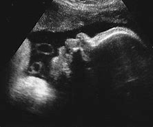 Image result for Male Baby Ultrasound