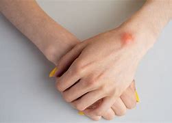 Image result for Ganglion Cyst in Capitate