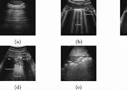 Image result for Lung Ultrasound B Lines Pulmonary Edema