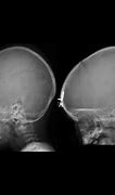 Image result for Skull Fracture