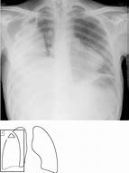 Image result for Empyema Thoracis X-ray