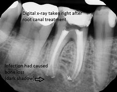 Image result for Root Canal Darkening