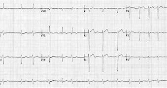 Image result for Atrial Fibrillation 12 Lead ECG