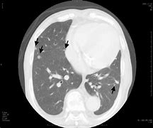 Image result for Multiple Lung Nodules