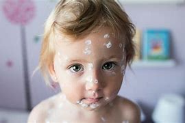 Image result for Pox Baby Girl