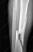 Image result for X-ray of Leg with Metal Plates