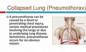 Image result for Signs of Collapsed Lung