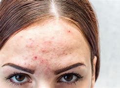 Image result for Pustules On Forehead