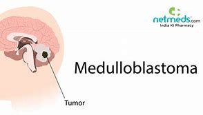 Image result for Medulloblastoma Location Diagram