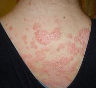 Image result for Scaly Rash