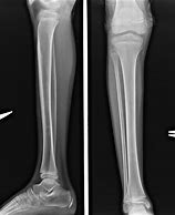 Image result for X-ray of Leg with Metal Plates