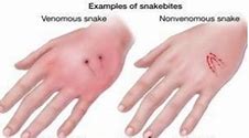 Image result for Dry Snake Bite