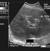 Image result for Biloma Ultrasound Images Post-Cholecystectomy