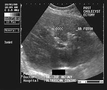 Image result for Cholecystectomy Ultrasound