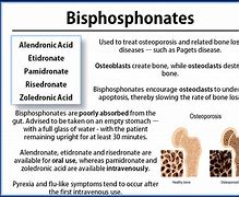 Image result for IV Bisphosphonate