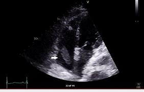 Image result for Right Atrial Thrombus Echocardiogram