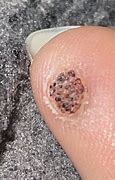 Image result for Filiform Wart On Finger