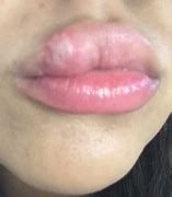 Image result for Bug Bite On Lip