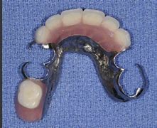 Image result for Upper Partial Dentures Pictures