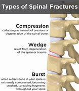 Image result for T12-L1 Back Pain