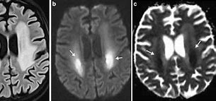 Image result for Toxic Leukoencephalopathy