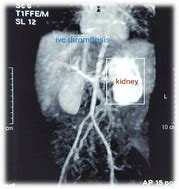 Image result for IVC Thrombs Post-Mortem