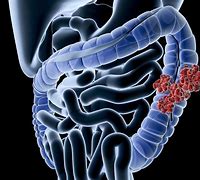 Image result for Cancer De Colon Tac