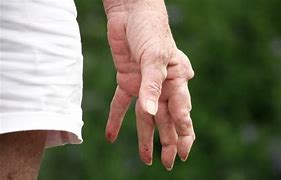 Image result for Rheumatoid Arthritis Nodules On Feet