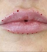 Image result for Bad Lip Fillers