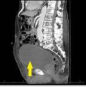 Image result for Distended Bladder