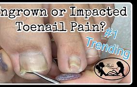 Image result for Pedicure for Ingrown Toenail