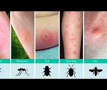 Image result for Baby Bed Bug Bites