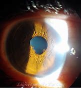 Image result for Uveitis Eye Disease