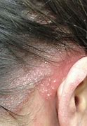 Image result for Psoriatic Pustules