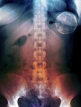 Image result for Cyst On Spleen