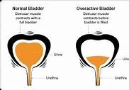 Image result for Overactive Bladder Surgery