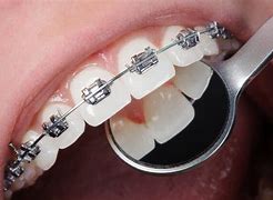 Image result for Fixed Braces Teeth Side View