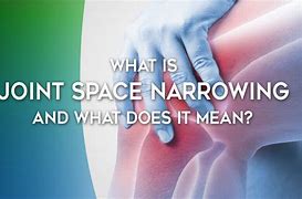 Image result for Hip Joint Space Narrowing