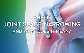 Image result for Patellofemoral Joint Space Narrowing