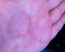 Image result for Red Flat Skin Lesion