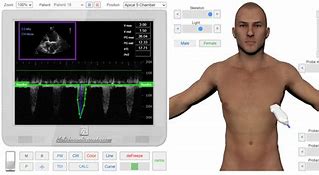 Image result for Aortic Stenosis Doppler