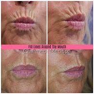 Image result for How to Remove Wrinkles around Mouth