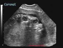 Image result for Anencephaly Ultrasound